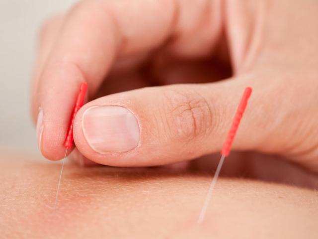 Seduta di agopuntura medica presso lo studio di Lecce della Dr.ssa Stefania D'Ettole