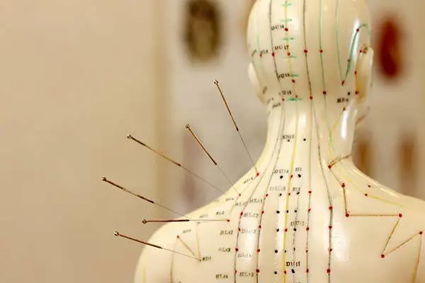 Agopuntura per il trattamento del dolore