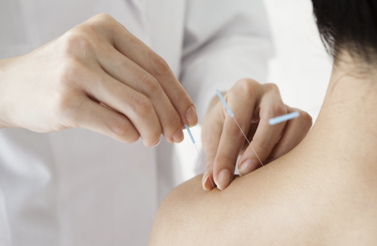 Seduta di agopuntura medica per il supporto oncologico a Lecce